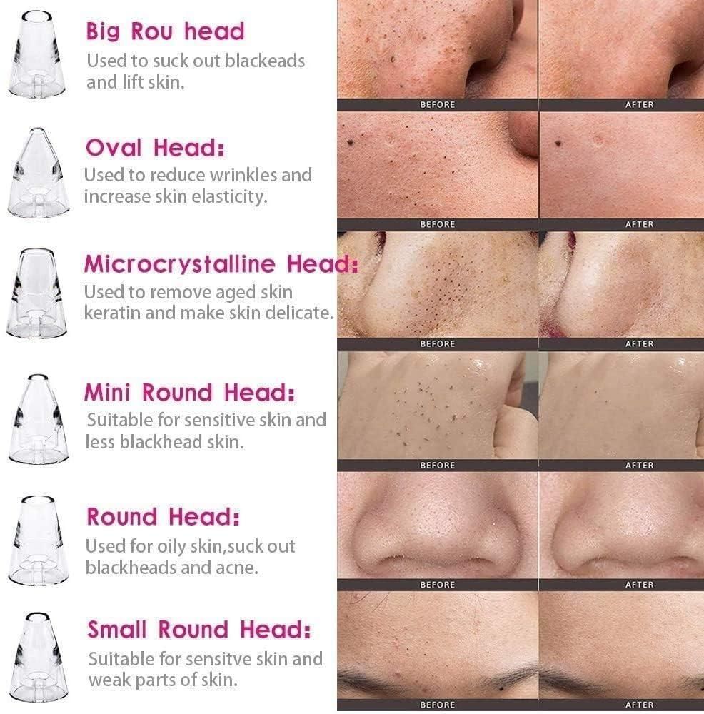 6 in 1 Blackhead Remover